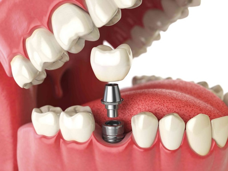 Тенденції та рекомендації в галузі зубної імплантації