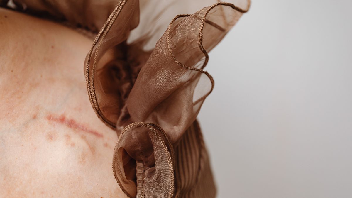 Захисники та захисниці України зможуть отримати безоплатні послуги з корекції рубцевих змін шкіри