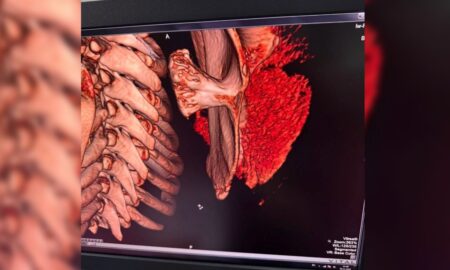 В обласній дитячій лікарні Франківська прооперували незвичайне пухлиноподібне утворення