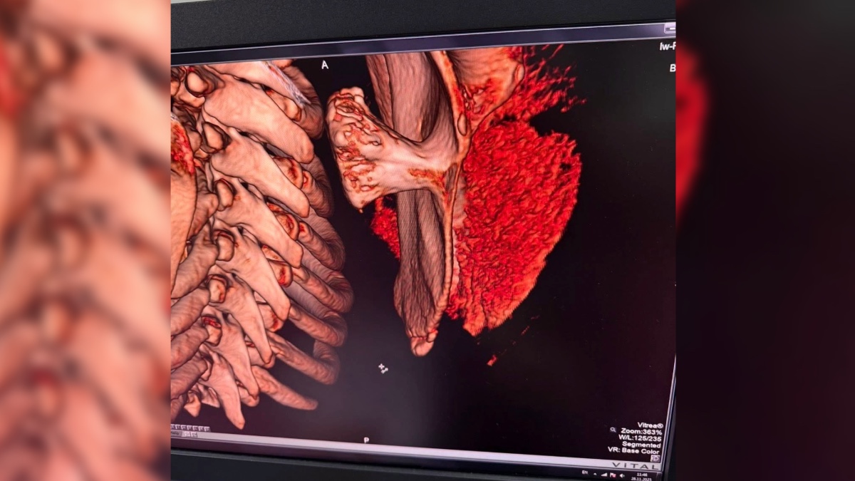 В обласній дитячій лікарні Франківська прооперували незвичайне пухлиноподібне утворення