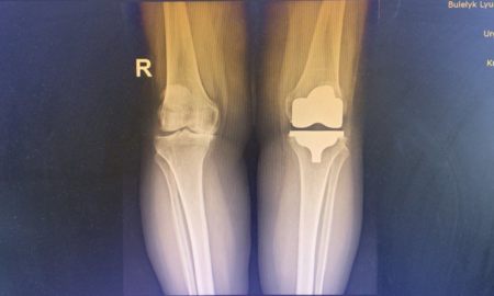 У Франківській ОКЛ впроваджують сучасний підхід до заміни колінного суглоба
