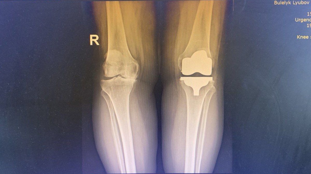 У Франківській ОКЛ впроваджують сучасний підхід до заміни колінного суглоба