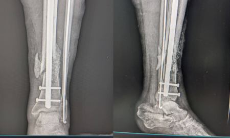 На Франківщині військовому відновили кістку за допомогою біоактивного біоскла