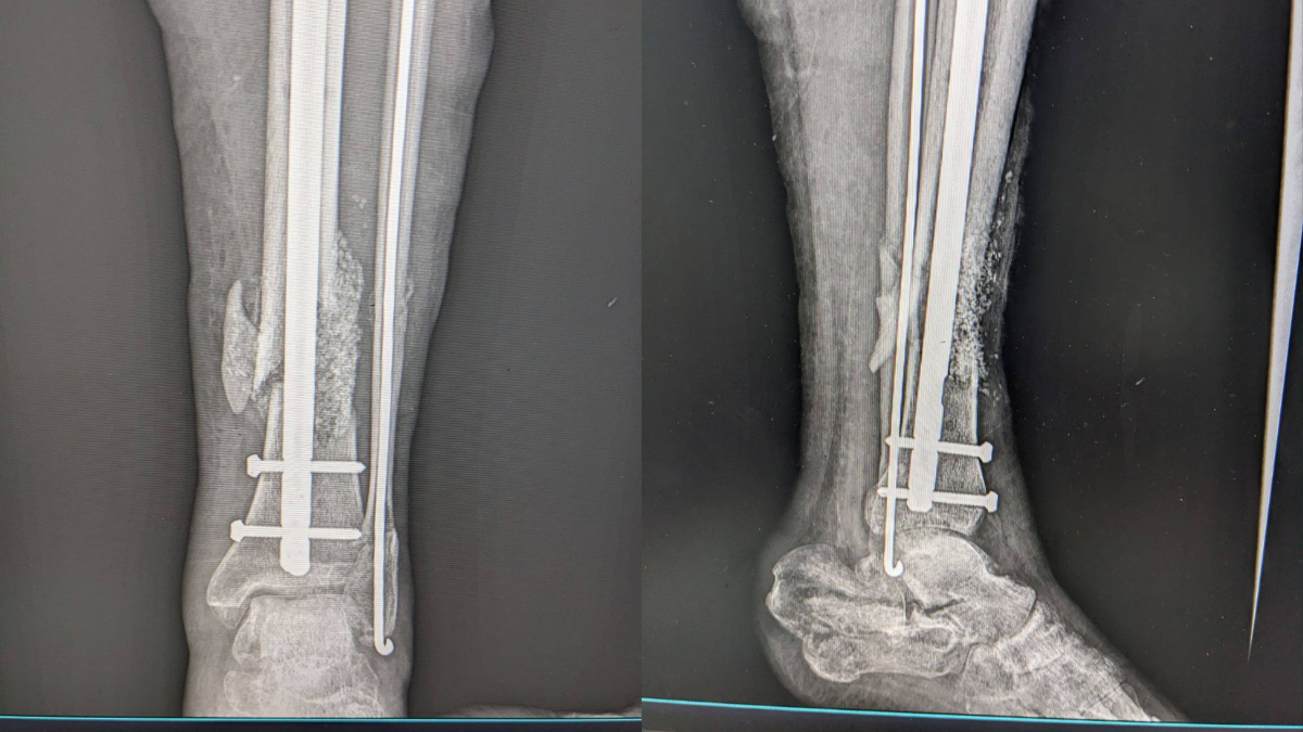 На Франківщині військовому відновили кістку за допомогою біоактивного біоскла