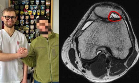 «Все могло завершитись ендопротезуванням»: франківські лікарі врятували коліно військовослужбовцю