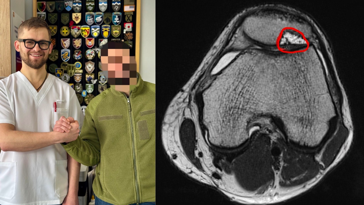 «Все могло завершитись ендопротезуванням»: франківські лікарі врятували коліно військовослужбовцю