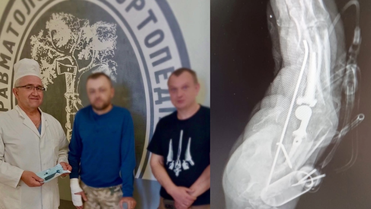У Франківську медики провели унікальну операцію, завдяки якій врятували руку військового