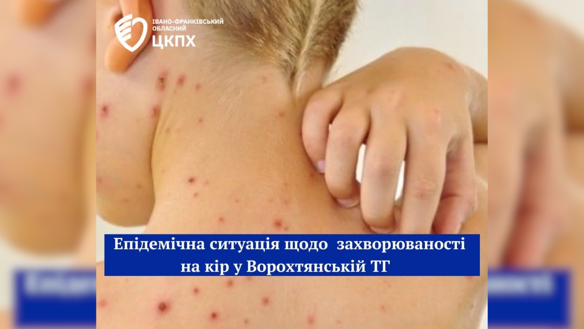 У Ворохті зафіксували чотири випадки кору: наразі діти одужали